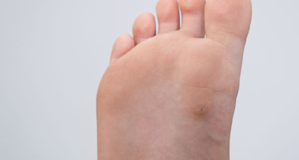 Como se contagia el papiloma del pie